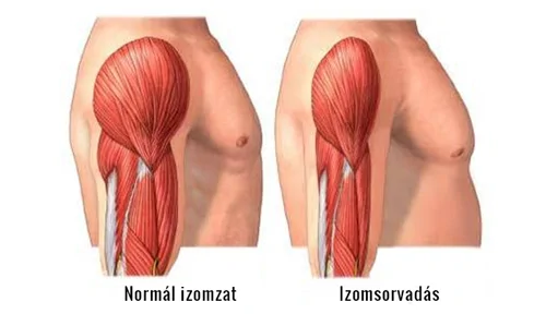 Izomsorvadás, az izomzat fokozatos leépülése