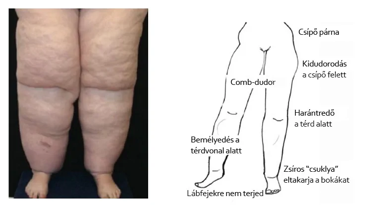 a lipödéma kilakulása és jellemző tünetei