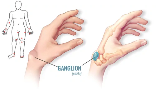 Ganglion &#8211; jóindulatú ciszta