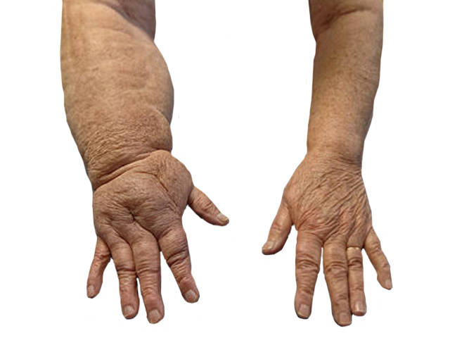 Gyógyszerek artrózis és ödéma kezelésére, Fájdalom a kéz és az alkar ízületeiben